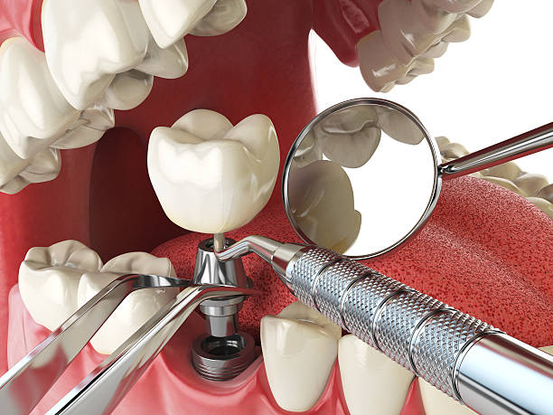 Best Emergency Wisdom Tooth Extraction in Rouse, CA